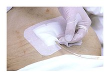 Artikelfoto Steriles Peg Verbandset m.Drainagekompresse 40St